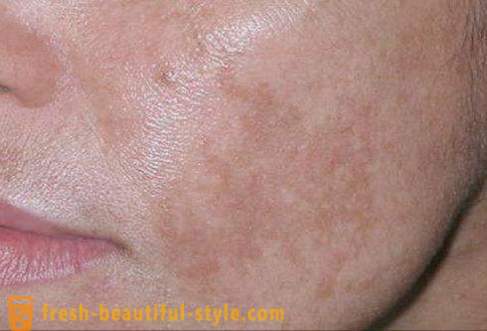 Rjave lise na obrazu: vzroki in zdravljenje. rjave lise