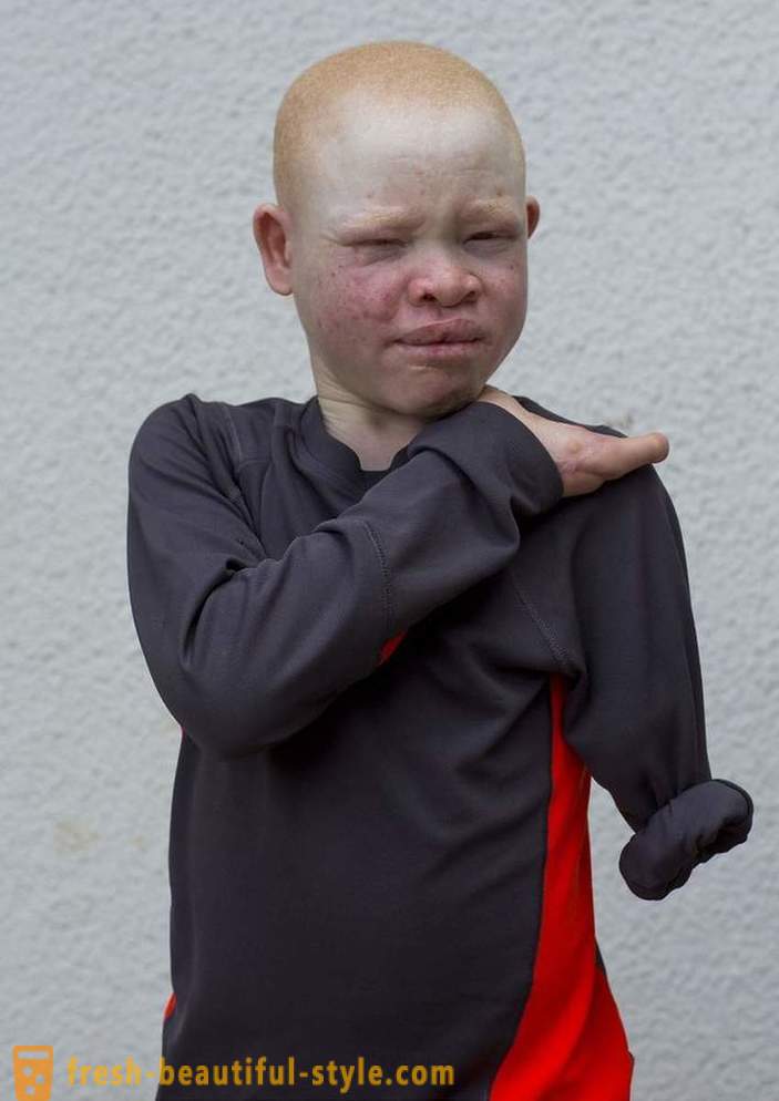 Tragična zgodovina tanzanijskih albinov
