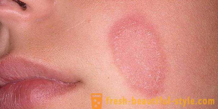 Luskasta koža na obrazu in rokah: možni vzroki in značilnosti nego