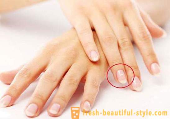 Bele lise na nohtih prstov: vzrokov in zdravljenja
