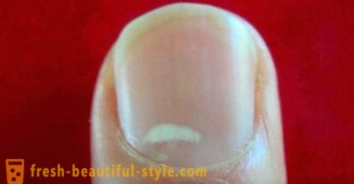 Bele lise na nohtih prstov: vzrokov in zdravljenja