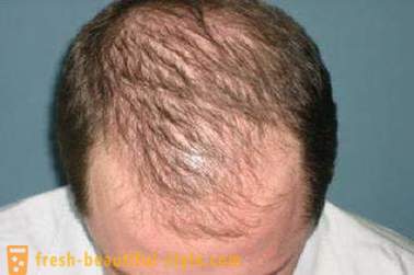 Kako pospešiti rast las na glavi? Obnova rasti dlak