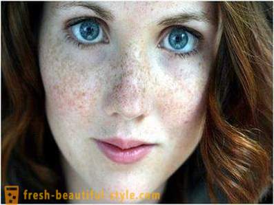 Skrbijo za svoje lepote in mladosti: povzroča pigmentacijo na obrazu